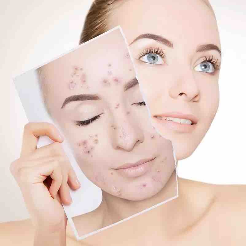 estetica-beauty-salon-wombwell-barnsley-ipl-skin-treatments-img